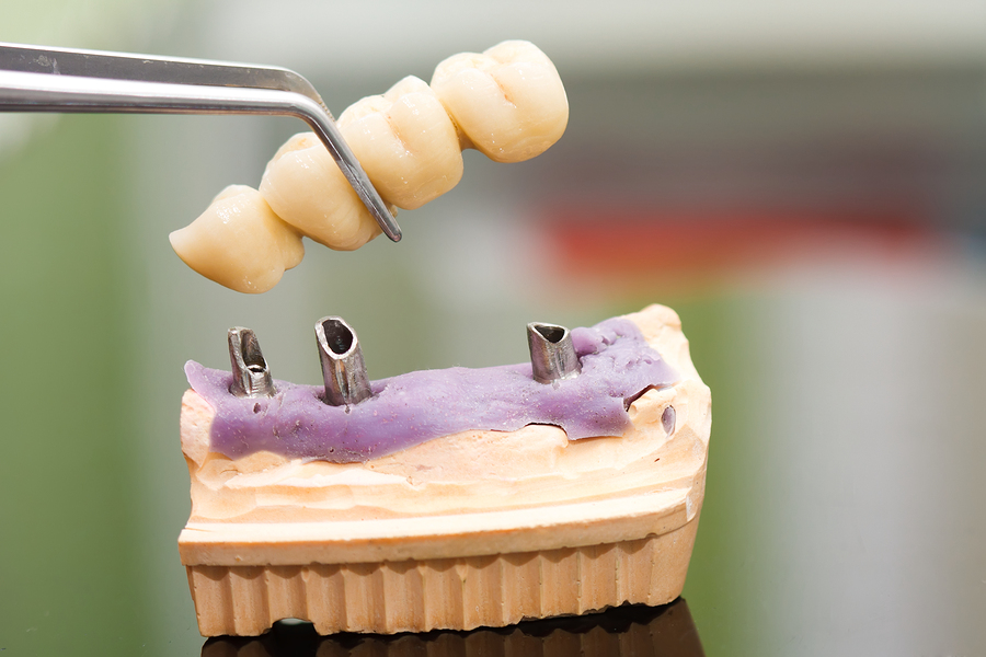 Dental Implants Fairfax, VA - Dr. Stephen St. Louis